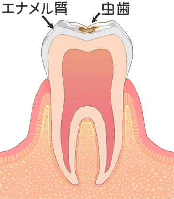 虫歯Ｃ１