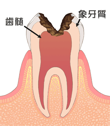 虫歯Ｃ３