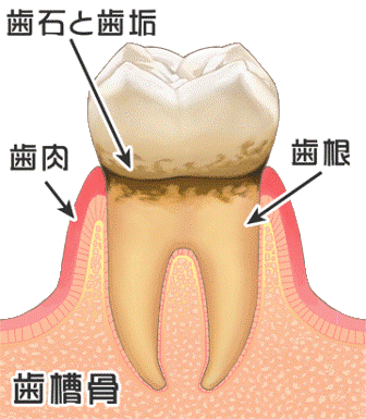 歯周歯石