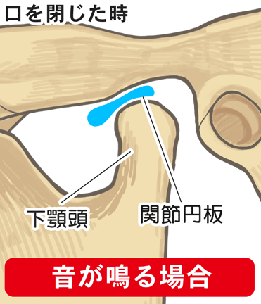 閉口時クリック・クレピタス