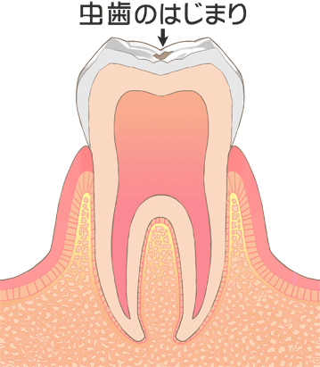 初期う蝕