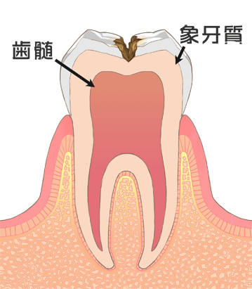 虫歯Ｃ２