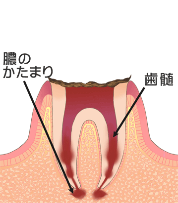 虫歯Ｃ４