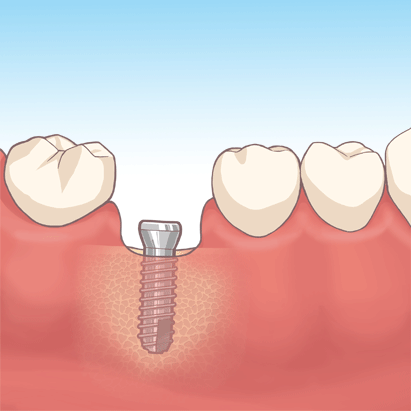 インプラント２