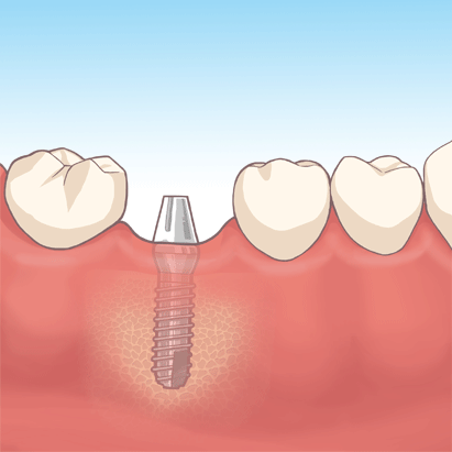 インプラント３