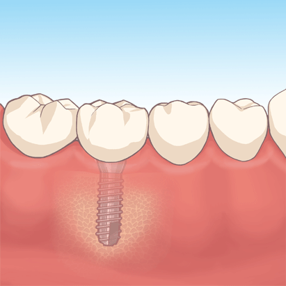 インプラント４