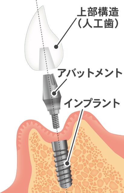 インプラント装着前