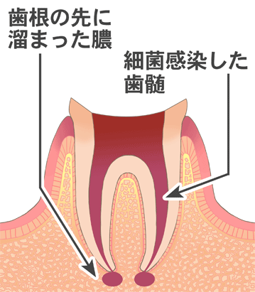 感染根管治療１