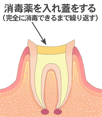 感染根管治療３