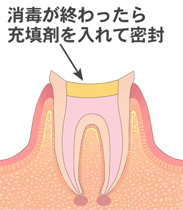 感染根管治療４