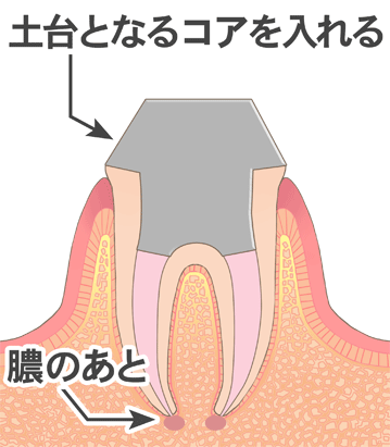 感染根管治療５