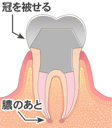 感染根管治療６