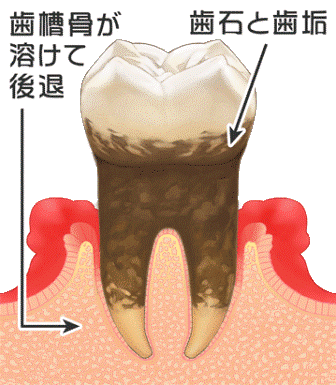 歯周病